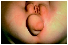 This infant was born with female and male genitalia. (Photograph by Mike Peres. Custom Medical Stock Photo, Inc.)