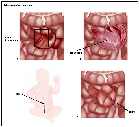 Intussusception of the bowel results in the bowel telescoping onto itself (A and B). To repair it, an incision is made in the babys abdomen to expose the bowel (C). If the surgeon cannot manipulate the bowel into a normal shape manually, the ar