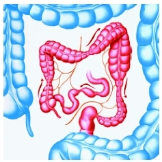Normal and diseased (center) colons. Areas of constriction in the colon cause constipation, while areas of distention cause diarrhea. ( 1995 John Bavosi/Science Photo Library. Custom Medical Stock Photo, Inc.)