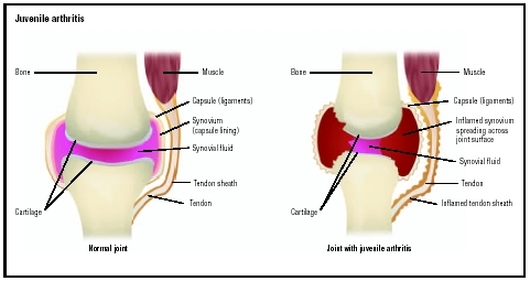 Normal knee joint (left) and one affected by juvenile arthritis, which shows damaged cartilage and inflammation of the synovial fluid and tendon sheath. (Illustration by GGS Information Services.)
