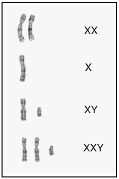 Sex chromosomes showing different phenotypes: XXnormal female; Xfemale with Turner syndrome; XYnormal male; and XXYmale with Klinefelter. (Lerner  Lerner, LLC.)