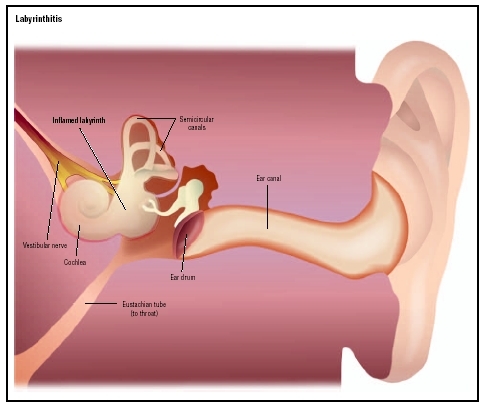 Labyrinthitis, or inner ear infection, causes the labyrinth area of the ear to become inflamed. (Illustration by GGS Information Services.)
