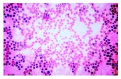Chronic lyphocytic leukemia cells, colorized and magnified 400 times. ( 1999 Custom Medical Stock Photo, Inc.)