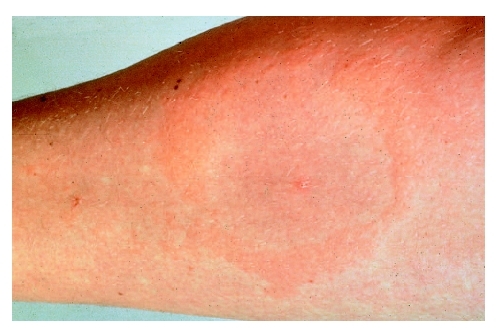 The first sign of lyme disease is usually an itchy bulls-eye rash around the site of the tick bite. ( 1993 Science Photo Library. Custom Medical Stock Photo, Inc.)