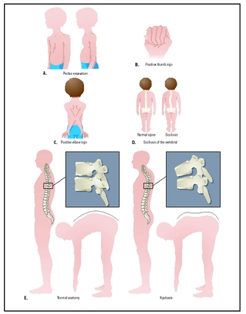 Five clinical signs of Marfan syndrome: (left to right) pectus excavatum, positive thumb sign, positive elbow sign, normal spine compared with scoliosis, normal anatomy compared with kyphosis. (Illustration by Argosy, Inc.)