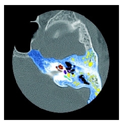 Computed tomography scan (CT scan) showing inflammation and fluid within the air spaces (represented in yellow) of the mastoid. ( Neil Borden/Photo Researchers, Inc.)