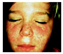 Measles rash on a childs face. ( CNRI/Photo Researchers, Inc.)