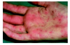 A close-up image of a persons hand with meningococcemia, caused by Neisseria meningitidis. The organism can cause multiple illnesses and can damage small blood vessels. (Custom Medical Stock Photo Inc.)