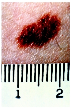 Close up of a mole. (Custom Medical Stock Photo Inc.)