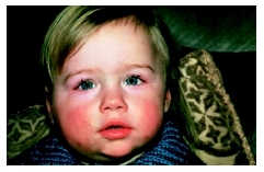 A young child with mumps. (Photo Researchers, Inc.)