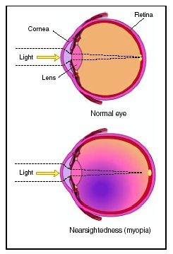 Myopia, or nearsightedness, is a condition of the eye in which objects are seen more clearly when close to the eye while distant objects appear blurred or fuzzy. (Illustration by Electronic Illustrators Group.)