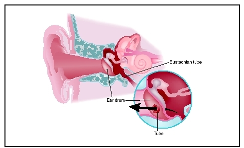 The insertion of ear tubes in the eardrum helps to alleviate chronic middle ear infections. (Illustration by Argosy, Inc.)