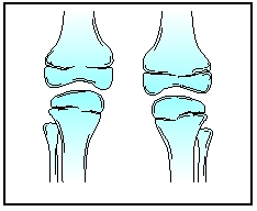 Illustration of bones around the knees showing absence of the patella in nail-patella syndrome. (Illustration by Argosy, Inc.)