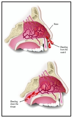 Anatomical sideview of a nosebleed. (Illustration by GGS Information Services)