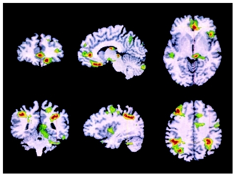 PET scans of a brain showing active areas in obsessive-compulsive disorder; positive correlations (activity increases as symptoms get stronger), top row; negative correlation (activity decreases as symptoms strengthen), bottom. (Wellcome Depart