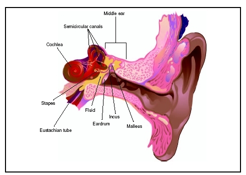 Otitis media is an ear infection in which fluid accumulates within the middle ear. A common condition occurring in childhood, it is estimated that 85 percent of all American children will develop otitis media at least once. (Illustration by Ele