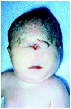Stillborn term infant with Pataus syndrome. The baby has no eyes, no nose opening, and anelongated bulb hanging from forehead. ( Ralph C. Eagle, M.D./Photo Researchers, Inc.)