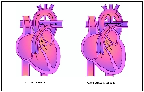 Patent ductus arteriosus (PDA) is the failure of the ductus arteriosus to close after birth, allowing blood to inappropriately flow from the aorta into the pulmonary artery. (Illustration by Electronic Illustrators Group.)