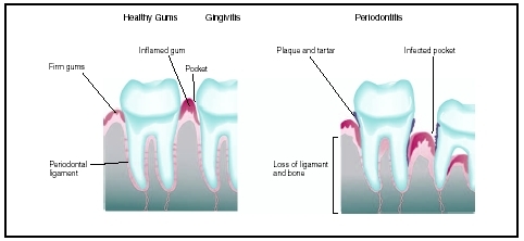Diagram showing healthy gums (far left) with no pockets or redness; gingivitis (left) with inflamed gum and pocket; and periodontitis (right) with infected pockets, plaque, and tartar. (Illustration by Argosy, Inc.)