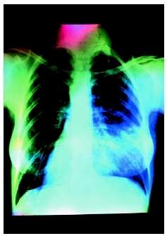 A chest x ray showing pneumonia in the lower lobe of a patients right lung. The alveoli (air sacs) of the lung become blocked with pus, which forces air out and causes the lung to become solidified. (National Audubon Society Collection/Photo Re