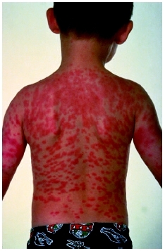 An unidentified rash on young boys back. (Custom Medical Stock Photo Inc.)