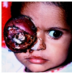 Childs right eye completely covered with a tumor associated with retinoblastoma. (Custom Medical Stock Photo Inc.)
