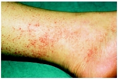 Rash caused by Rocky Mountain spotted fever. (Photograph by Ken E. Greer. Visuals Unlimited.)