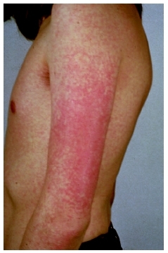 A red rash is one characteristic of rubella, or German measles, as seen on this teenagers arm. (Custom Medical Stock Photo, Inc.)