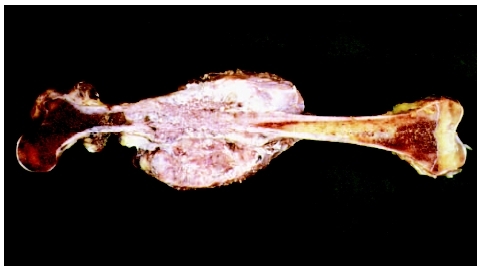 A specimen of a femur bone indicating the cancerous growth around the knee. Osteosarcoma is the most common primary cancer of the bone. (Photo Researchers, Inc.)