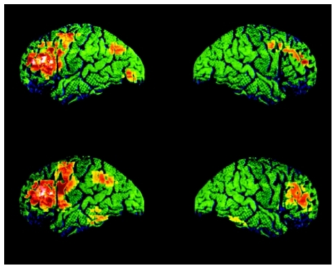 Colored positron emission tomography (PET) brain scans of a schizophrenic, bottom, and normal patient, top. ( Wellcome Dept. of Cognitive Neurology/Science Photo Library. Photo Researchers, Inc.)
