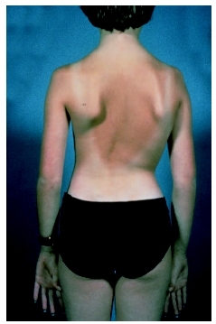 This patient suffers from scoliosis, or curvature of the spine. (Custom Medical Stock Photo Inc.)