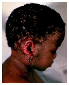 This young boy is afflicted with seborrheic dermatitis. (Custom Medical Stock Photo Inc.)