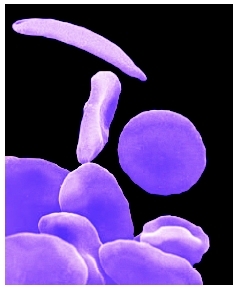 Normal red blood cells are smooth and round. In sickle cell anemia, the red blood cells become shaped like sickles or crescents. ( Dr. Gopal Murti/Photo Researchers, Inc.)