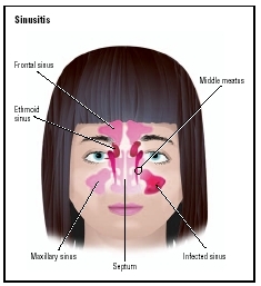 Illustration of an infected left maxillary sinus, which radiates pain and pressure to the surrounding sinus areas. (Illustration by GGS Information Services.)