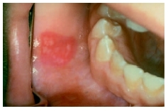 This patient is afflicted with stomatitis, a common inflammatory disease of the mouth. (Photograph by Edward H. Gill, Custom Medical Stock Photo Inc.)