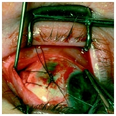 A close-up of ophthalmic surgery being performed to correct strabismus. (Photograph by Michael English, M.D. Custom Medical Stock Photo, Inc.)