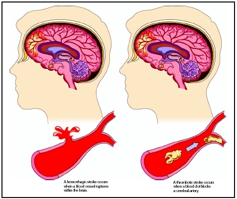 A hemorrhagic stroke (left) compared to a thrombotic stroke (right). (Illustration by Hans  Cassidy.)