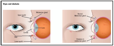 Illustration of a sty (left) and a chalazion. The sty appears on the margin of the eyelid, while the chalazion occurs deeper within the Meibomian gland of the eyelid. (Illustration by GGS Information Services.)