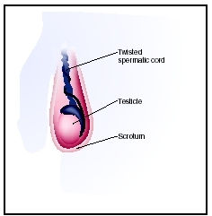 A rare condition, testicular torsion occurs when the spermatic cord is twisted and cuts off the blood supply to the testicle. (Illustration by Argosy, Inc.)