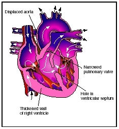 Tetralogy of Fallot is a common syndrome of congenital heart defects. This condition, present in utero, is caused by the narrowing of the pulmonary artery and a hole between the ventricles. When the baby is born and begins to breathe on its own