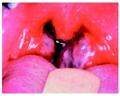 An examination of this patients mouth reveals acute tonsillitis. ( 1993 NMSB. Custom Medical Stock Photo, Inc.)