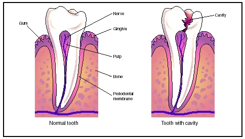 Tooth decay is the destruction of the outer surface, or enamel, of a tooth. It is caused by acid buildup from plaque bacteria, which dissolve the minerals in the enamel and create cavities. (Illustration by Electronic Illustrators Group.)