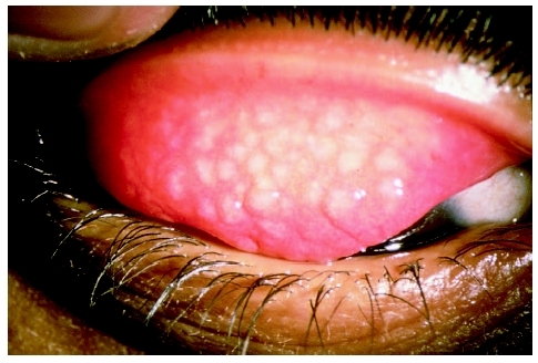 A close-up of a human eye with trachoma. Trachoma is caused by Chlamydia trachomatis and commonly results in blindness if left untreated. (Custom Medical Stock Photo Inc.)