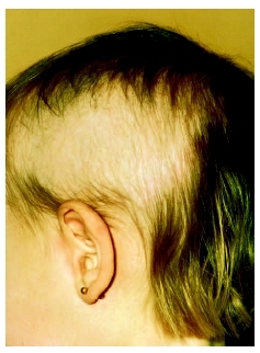 Childs scalp showing hair loss from trichotillomania. ( NMSB/Custom Medical Stock Photo.)