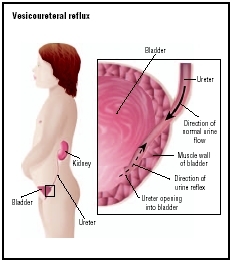 Illustration of vesicoureteral reflux in a child, a condition in which urine abnormally flows back up into the ureters, causing repeated urinary tract infections. (Illustration by GGS Information Services.)