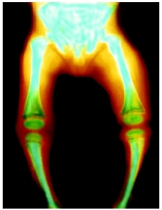 X ray of a childs lower body affected by rickets, a result of a vitamin D deficiency. ( Dr. LR/Photo Researchers, Inc.)