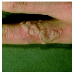 Cluster of warts on a finger. (Custom Medical Stock Photo Inc.)